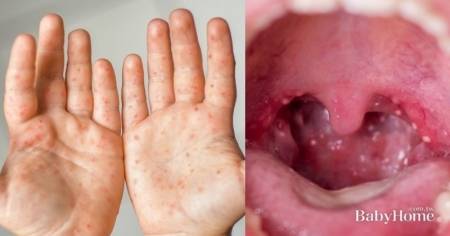 超強傳染力腸病毒症狀詳解，兒童嘴巴小白點、水泡、紅疹，腸病毒多久會好？