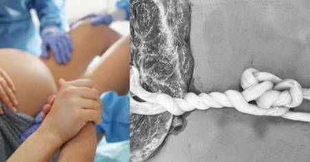 晚1天變連體嬰！台大醫接生雙胞胎「臍帶纏繞、大腿被套圈」 驚險過程曝光